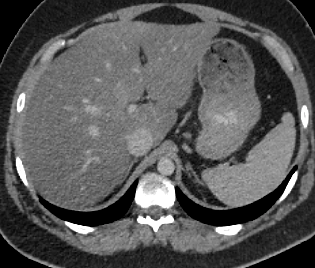 Axial abdominal CT slice from the TotalSegmentator learning scan