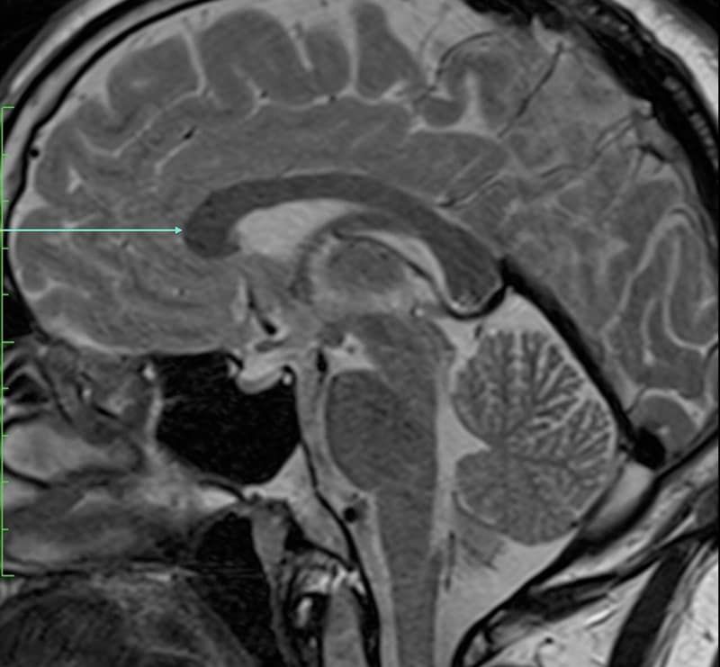 Radiology image with an arrow marking a structure to name — Genu of corpus callosum