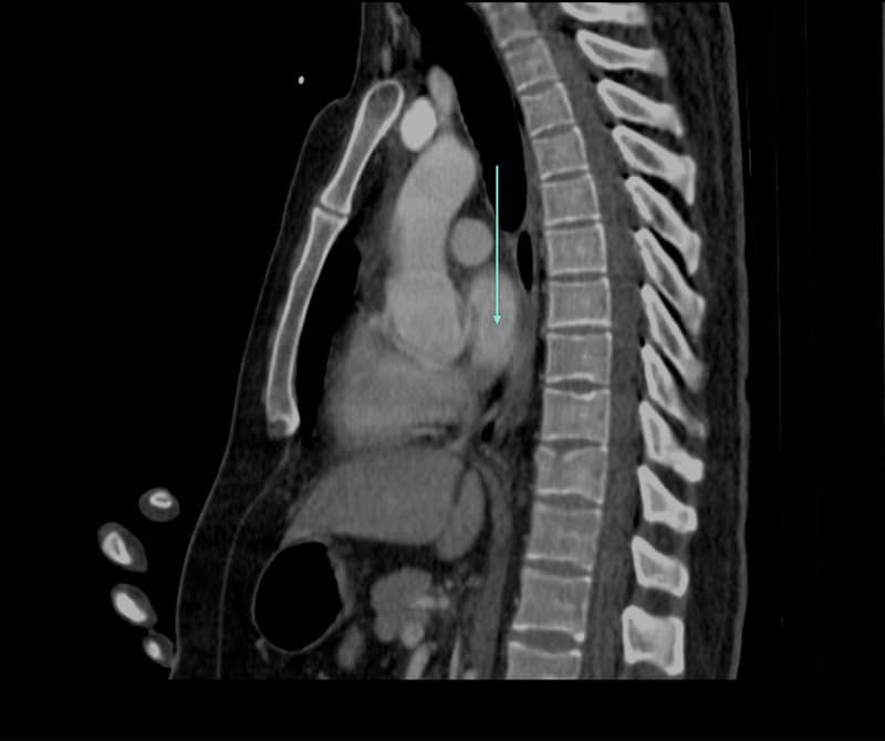 Radiology image with an arrow marking a structure to name — Left atrium