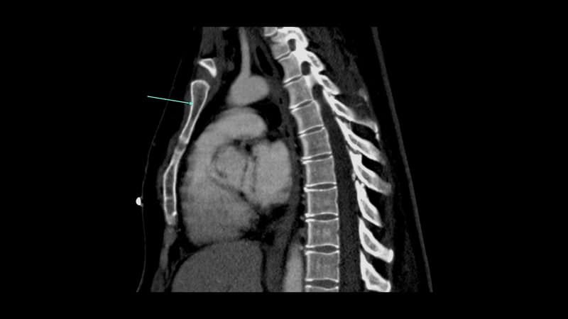 Radiology image with an arrow marking a structure to name — Manubrium of sternum
